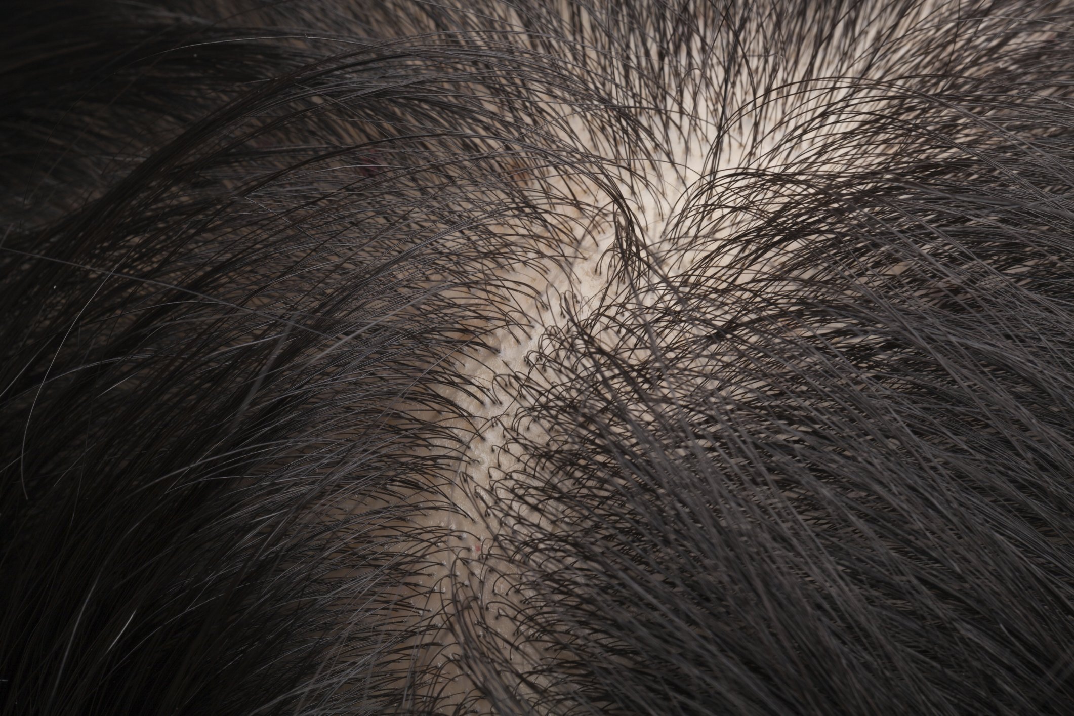 Is My Hair Loss Genetic, or Can I do Something Different? | Allusions