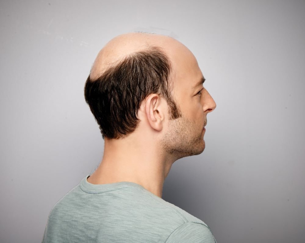 NonSurgical Hair Replacement in India  Hair Systems for Men